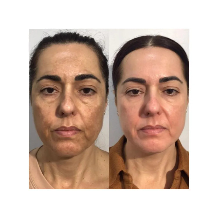 سرم پیل شات کوجیک اسید و زردچوبه دکتر ملاکسین لایهبردار ملایم و روشنکننده قوی پوست Dr.Melaxin Peel Shot Exfoliating Kojic Acid Turmeric Serum